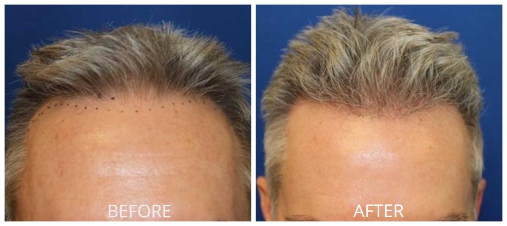 All about the benefits of orange county hair restoration treatment